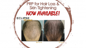 PRP (Platelet Rick Plasma) for hair loss and skin tightening