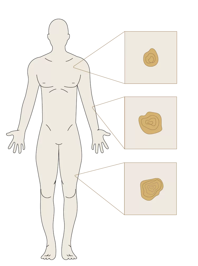 Skin Cancer Screening - Dermatology and Skin Cancer Center Identifying Skin Cancer