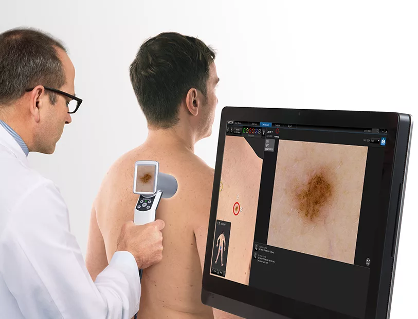 Skin Cancer Close-Up - Dermatology and Skin Cancer Center Analyzing Skin Cancer